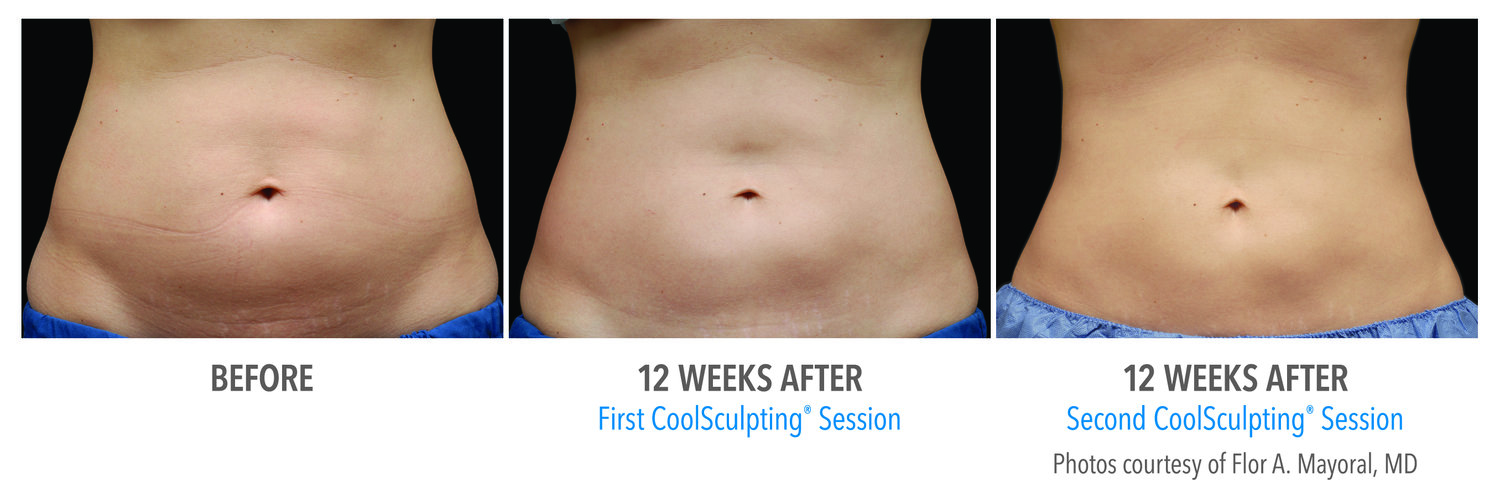 CoolSculpting Services in a Clinic