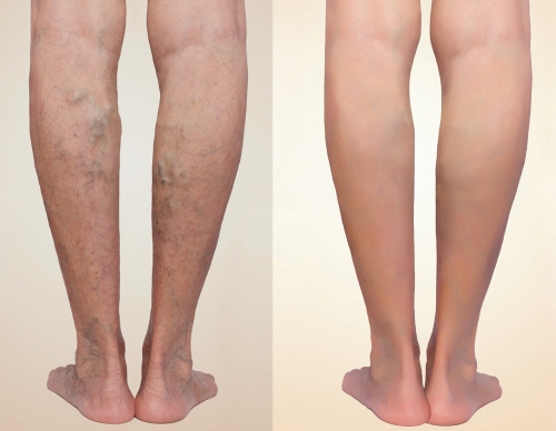 How Long Do I Wear Compression Stockings After Spider Vein Treatment?