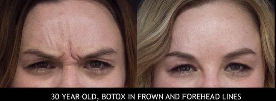 before and after botox