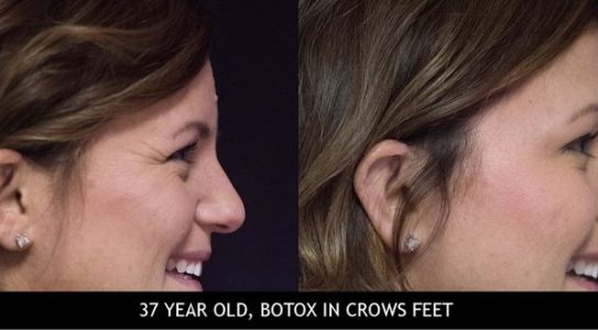 37-year-old-botox-in-crows-feet-min-phn73hl1mgrq8vn42r3e2emhll6rfgnhj5czs1kt4o