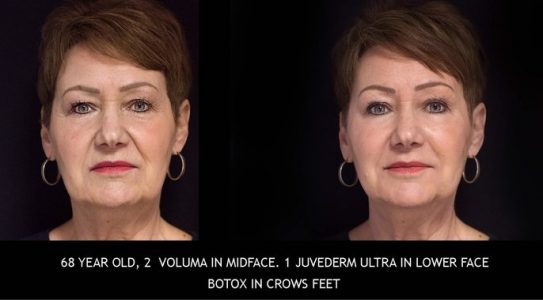68-year-old-2-volume-in-midface.-1-juvederm-ultra-in-lower-botox-in-crows-feet-min-phn73jgq04uaw3kdrrwn7e5escxhuuuy7enyqli0s8