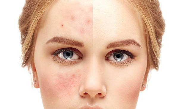 woman with acne problems