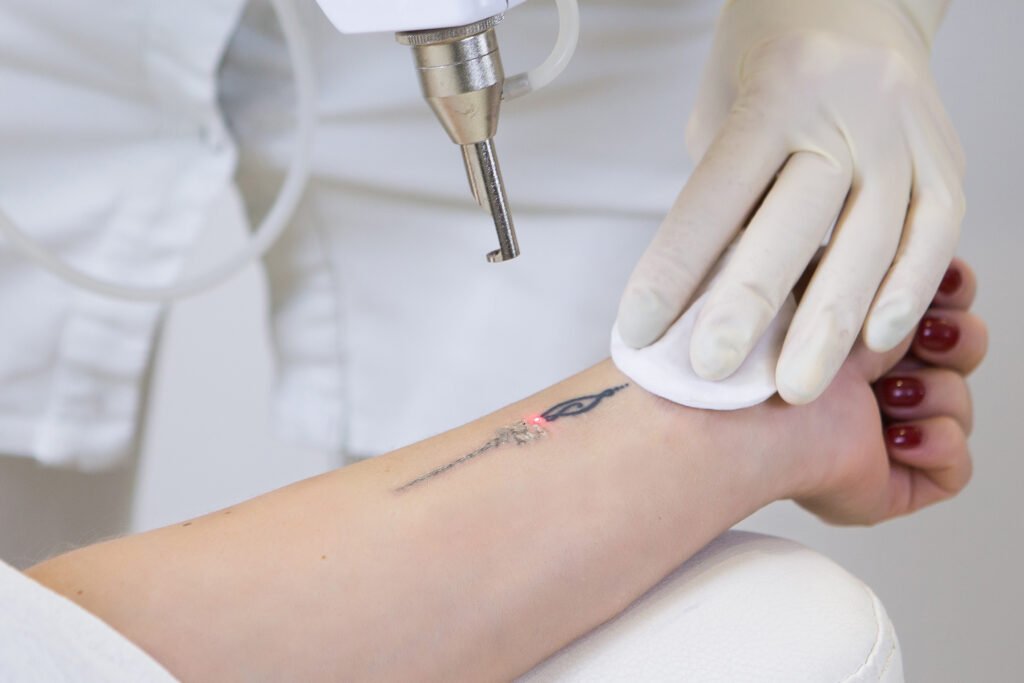 woman receiving a laser tattoo removal treatment