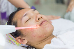 Beauty treatment of face skin with high frequency infrared spot or laser spot remover in SPA center.