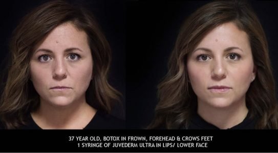 37-year-old-botox-in-frown-forehead-crows-feet-min-phn73iivtat0khlqx9i0mwdy6z24n5r7va0h9bjeyg