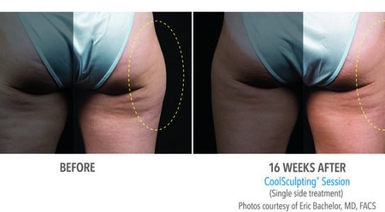 coolsculpting session single side treatment-min